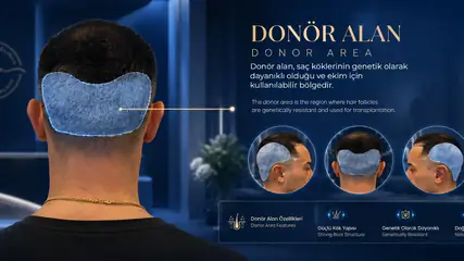 Saç Ekiminde Donör Bölge Nedir? Doğru Planlama Rehberi