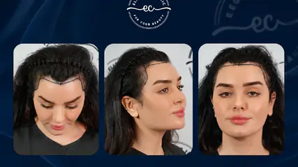 Kadınlarda Saç Ekimi Hangi Durumlarda Tercih Edilir?